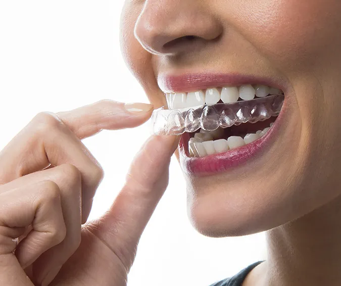 Invisalign Aligners & Braces